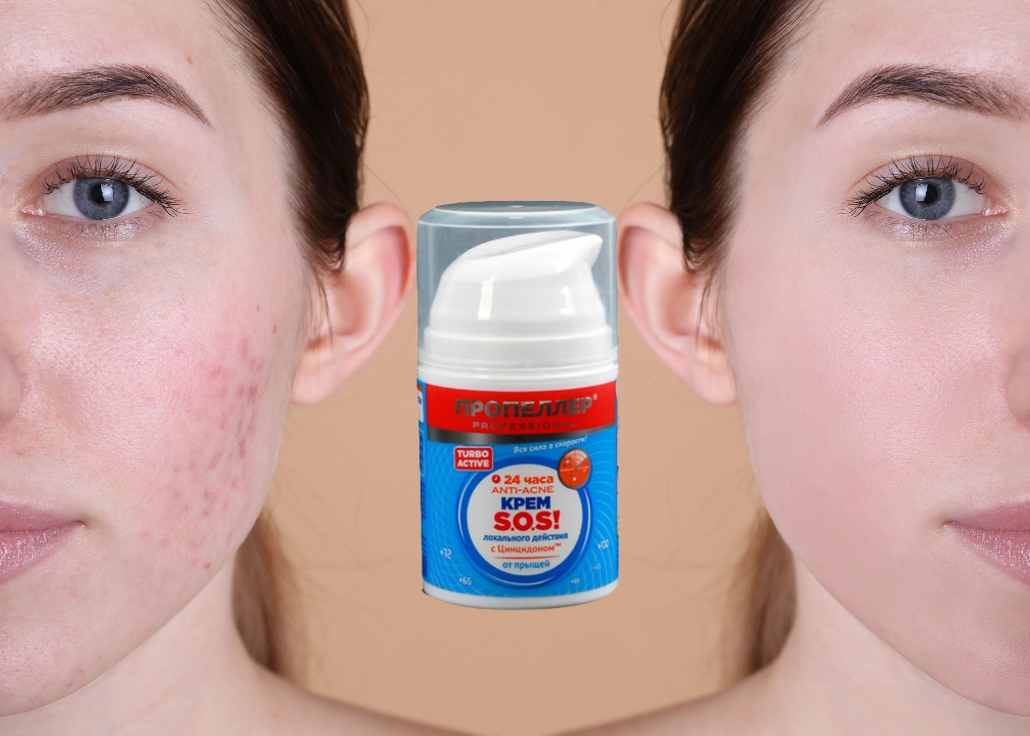 Kem đặc trị mụn SOS Nga Dưỡng Da Mặt-1