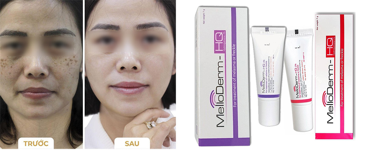 Thuốc Trị Nám Tàn Nhang Đồi Mồi Mello Derm-HQ 4% Thái Lan Dưỡng Da Mặt-1